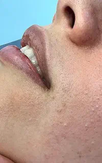 پاکسازی و فشیال ودرمان تخصصی پوست