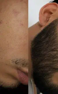 رویش مجدد ریش و مو