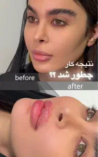 تزریق ژل و بوتاکس بهاره