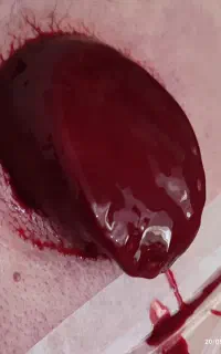 حجامت و فصد خون تخصصی با بیش از نوزده سال سابقه