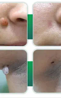حذف خال، کک‌ومک،میخچه و زوائد پوستی با کمترین قیمت