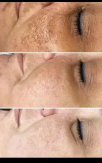 کک و مک هات را در یک جلسه بردار هر دونه فقط۳۰هزارت