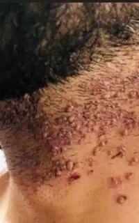 تبخال تناسلی