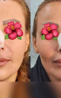 جشنواره تخفیف  بوتاکس و ژل لب  فقط به مدت۳روز
