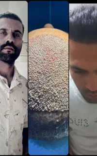 کاشت ابرو بدون نیاز به جراحی کاشت مو شیرازیvip
