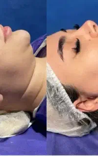 ساکشن غبغب و‌بوکال فت بدون جراحی