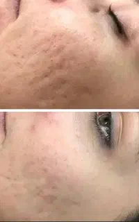 لیزر نواحی تیره بدن