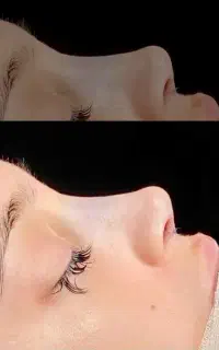 عمل بینی/جراحی بینی/اهواز