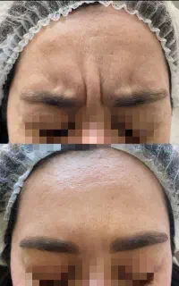 جشنواره تخفیف ژل و بوتاکس فقط امروز ۲۵ ام