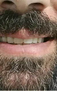 دندان  مصنوعی متحرک کامل و تکه ای