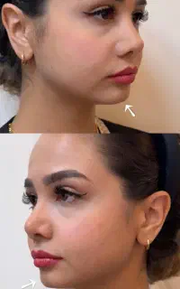 کانتورینگ صورت با فیلر.زاویه سازی،فرم‌دهی،حجم دهی