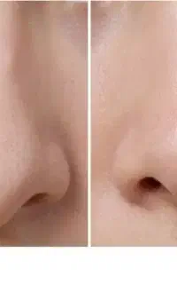 تغییر فرم بینی بدون جراحی