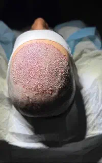 کاشت مو تضمینی با شرایط عالی در سقز