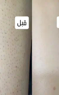 تخفیف 20%لیزر موهای زائددستگاه شاتی