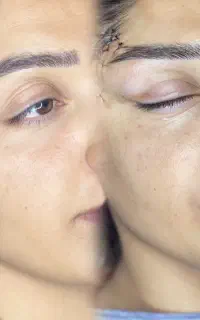 لیفت دائم صورت با قیمت استثنائی تا مدت محدود