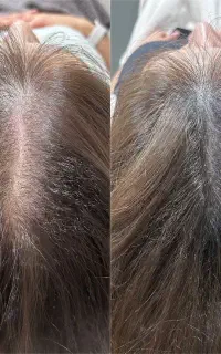 مزو و کربوکسی مو برای رویش دوباره