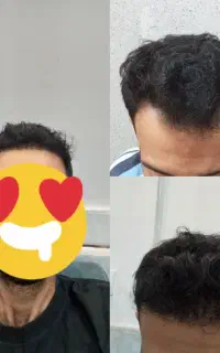 انجام کاشت مو به روش super micro fit