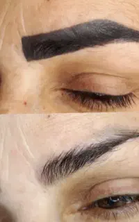 ریموو تتو با رژوی پلاس آمریکایی