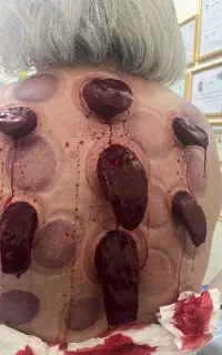 حجامت تخصصی و درمانی و ویژه