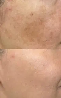 جشنواره تخفیف ویژه خدمات پاکسازی پوست وفیشال محدود