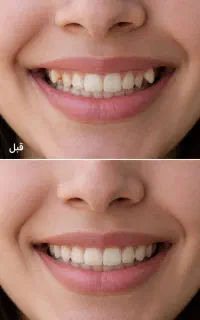 ارتودنسی شفاف نامرئی،بدون سیم + پرداخت اقساطی