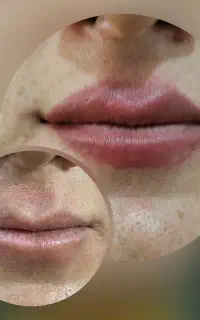 ایلام حذف تاتو با لیزر