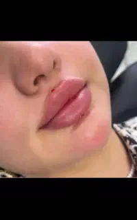 افر ویژه ژل بوتاکس