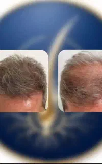 چهار روزه کمپشتی ریش و موهاتو درمان کن