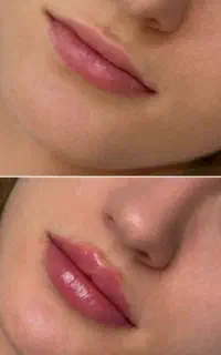 تخفیف یک هفته ای فیلر، بوتاکس،مزو،prp