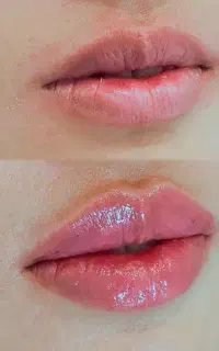 جشنواره ژل(فیلر)، بوتاکس،مزوتراپی و PRF توسط پزشک
