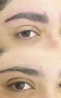تخفیف میکروبلیدینگ