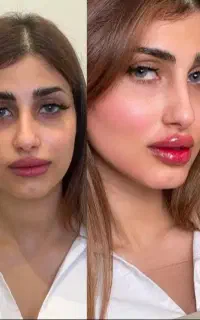 تزریق ژل،بوتاکس،فیلر،مزوتراپی،پی آر پی هایفو