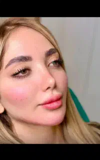 تزریق فیلر و‌ ژل لب و‌بوتاکس تضمینی با آف 50 درصدی