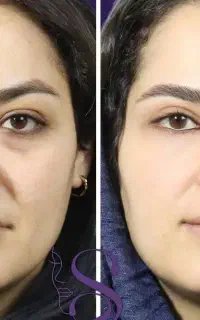 بلفاروپلاستی با جدید ترین متد