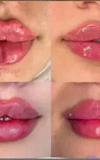 ژل وبوتاکس صورت وبدن