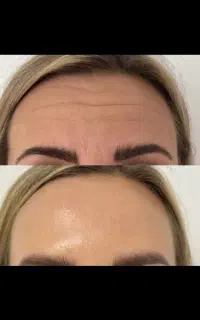 بوتاکس فول فیس(کل صورت)
