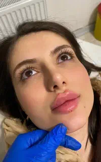 فیلر ژل صورت بوتاکس مزو خالبرداری ریمو تتو مزوژل