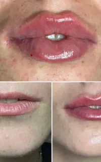 آموزش فیلر و بوتاکس و مزوژل