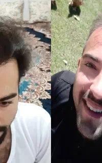 کلینیک تخصصی کاشت مو کاشت ابرو
