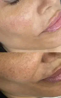 پوست درمانی با دستگاه الکتروپوریشن
