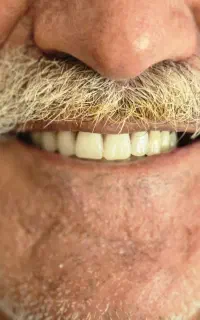 دندان/ژله‌ای/فلکسی/طرح کامپوزیت