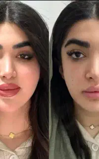 چربی،ژل،بوتاکس،پی آرپی ،بلفاروپلاستی و دایرکت ابرو
