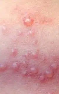 پاکسازی دائمی زیگیل و تبخال مقاربتی