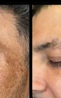 کرم لاکچری کوین و (گاتیو) بیوممتیک