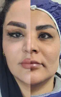 بلفاروپلاستی چشم روباهی‌فقط ۷.۹۹۰