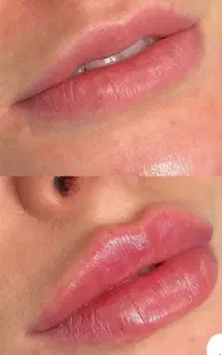 تزریق ژل بوتاکس مزوتراپی فیشیال با بهترین قیمت