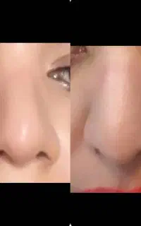 کوچک کردن بینی بدون جراحی و درد