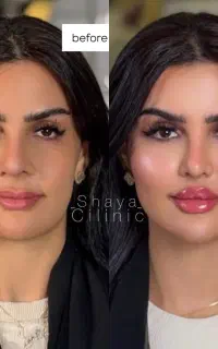 آف آموزش و تزریق فوق تخصصی فیلر بوتاکس(بمدت محدود)