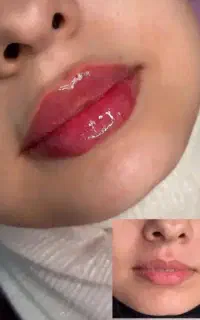 آفر ویژه تزریق فیلر ودرمان پوست و مو