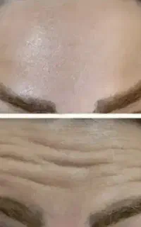 تزریق ژل بوتاکس درکلینیک